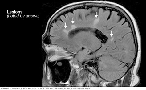 MRI and MS diagnosis .